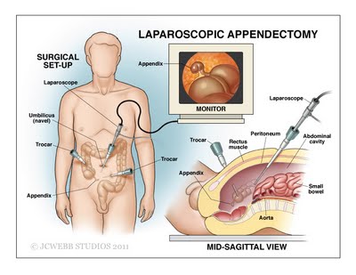 Laparoszkópos műtét illusztrációja